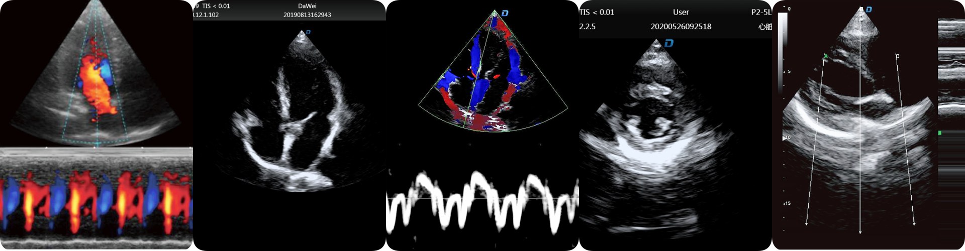 5 clear cardiac ultrasound imaging by Dawei medical ultrasound machines 5 échographies cardiaques claires réalisées par les échographes médicaux Dawei