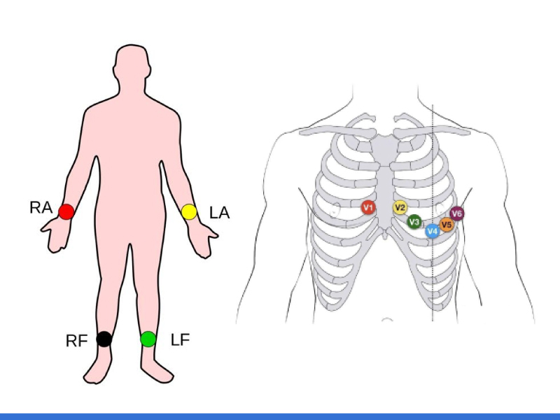 Composants de clés de placement de l'électrode ECG